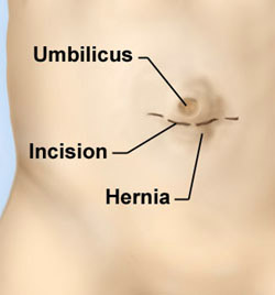 Repair of Umbilical (bellybutton) Hernia
