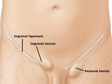 Femoral Hernia