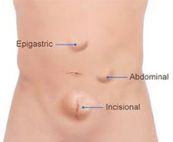 Incisional Hernia