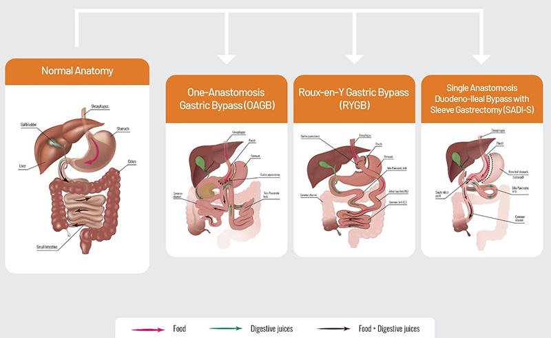 Laparoscopic Gastric Bypass