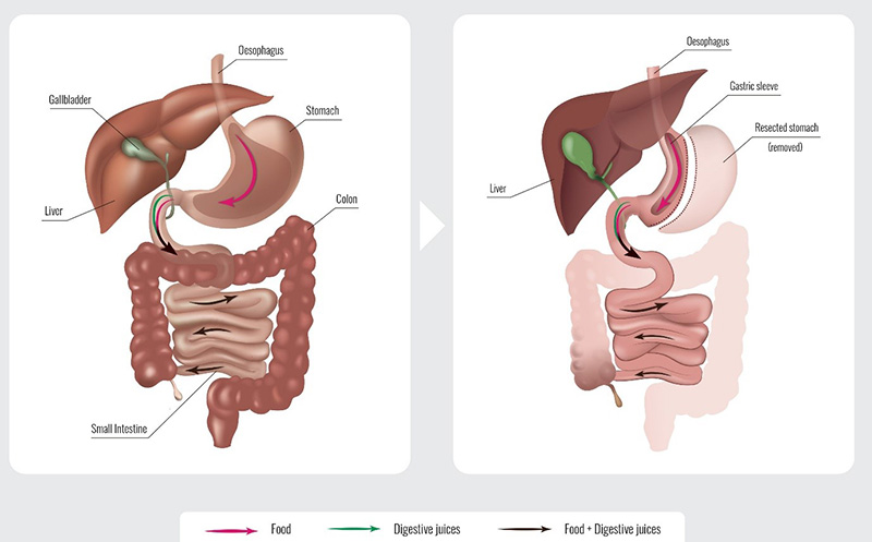 Laparoscopic Sleeve Gastrectomy