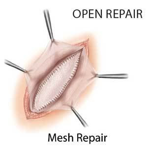 laparoscopic ventral incisional hernia surgery 