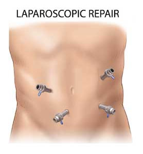 laparoscopic ventral incisional hernia surgery 