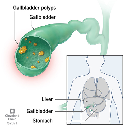 Medical illustration showing small outgrowths known as polyps on the internal lining of a human gallbladder
