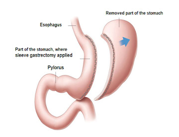 Weight loss (Bariatric) Surgery