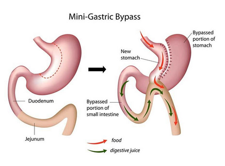 Weight loss (Bariatric) Surgery